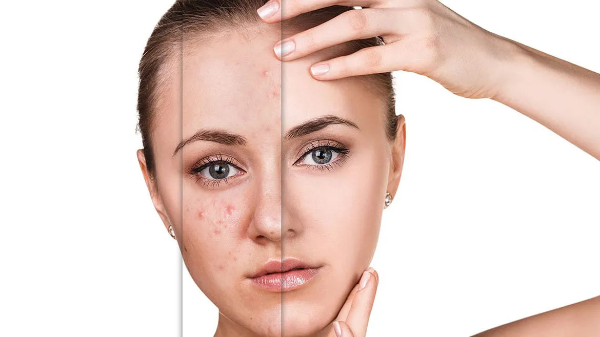 Anti Pimple products